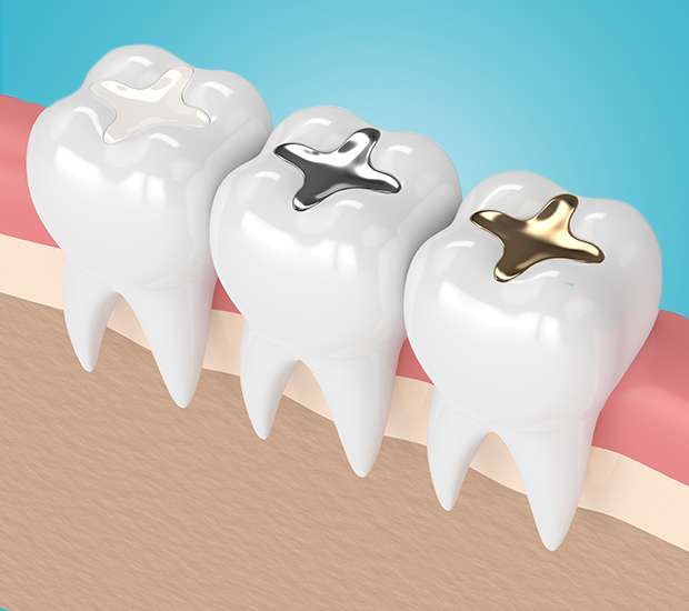 Tulare Composite Fillings