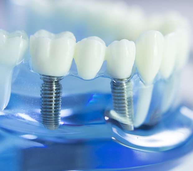 Tulare Dental Implants