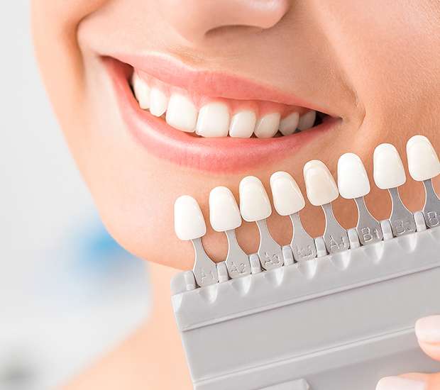 Tulare Dental Veneers and Dental Laminates