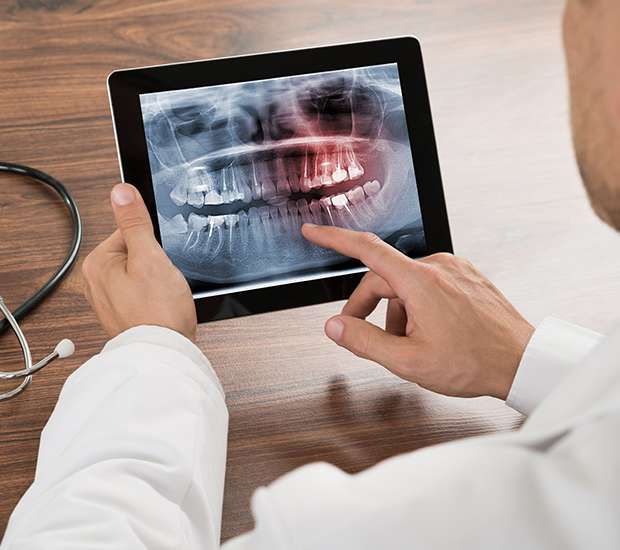 Tulare Types of Dental Root Fractures